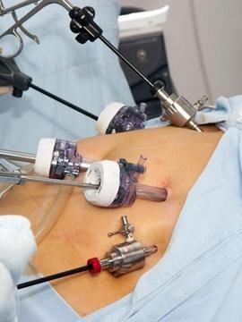 Gastric bypass surgery